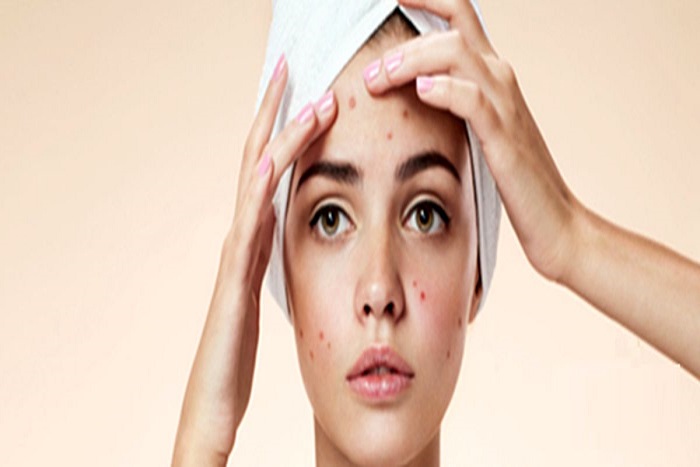 خواص کتیرا برای جوش صورت