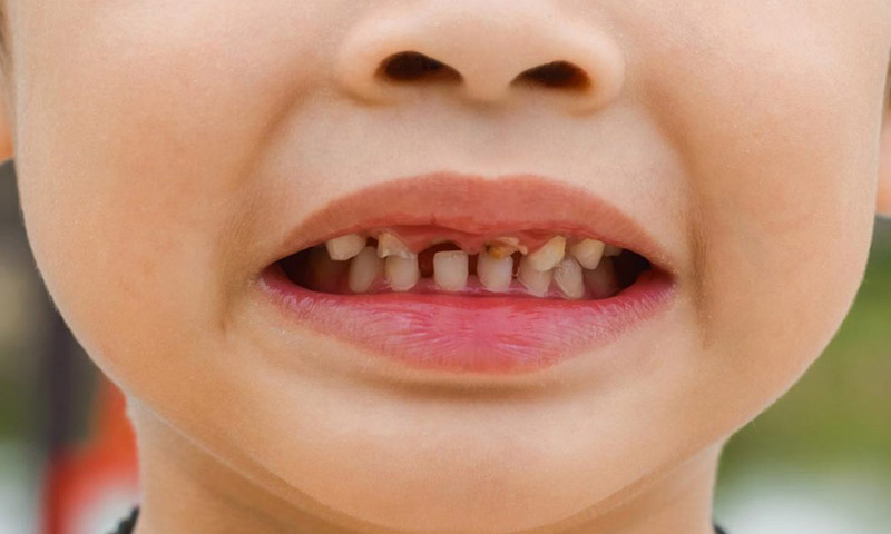 جلوگیری از پوسیدگی دندان کودکان