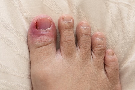 تشخیص عفونت ناخن پا, درمان عفونت ناخن پا, پماد برای عفونت ناخن پا