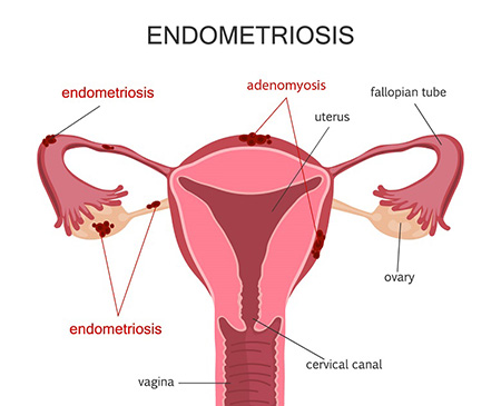 برای درمان اندومتریوز چه بخوریم برای درمان اندومتریوز چه بخوریم